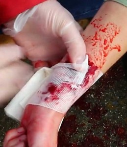 Bildet viser hvordan du kan stoppe blødningen
